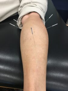 Dry needling